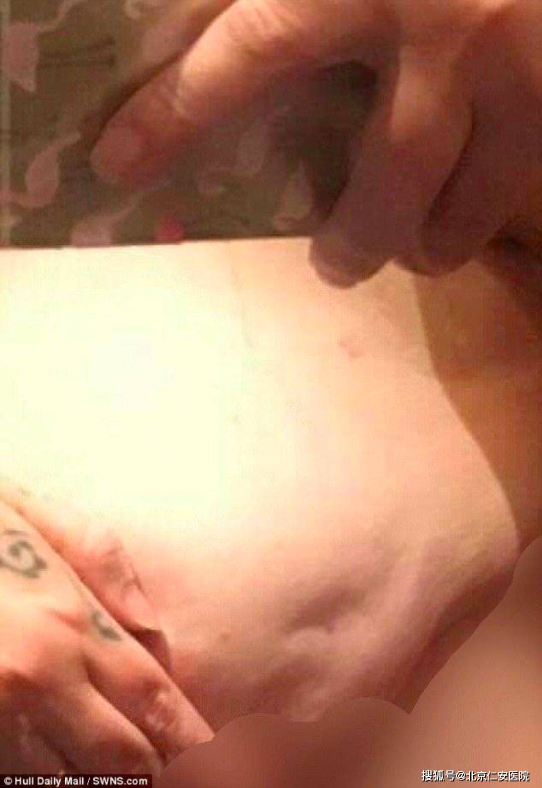 基孔基雅热的初期症状（基孔症治疗）