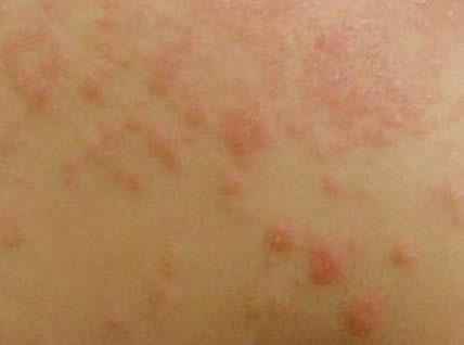 【被伊蚊咬了伤口表面图,被伊蚊咬了怎么止痒】