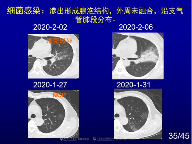 新冠肺炎后遗症/新冠肺炎后遗症CT表现