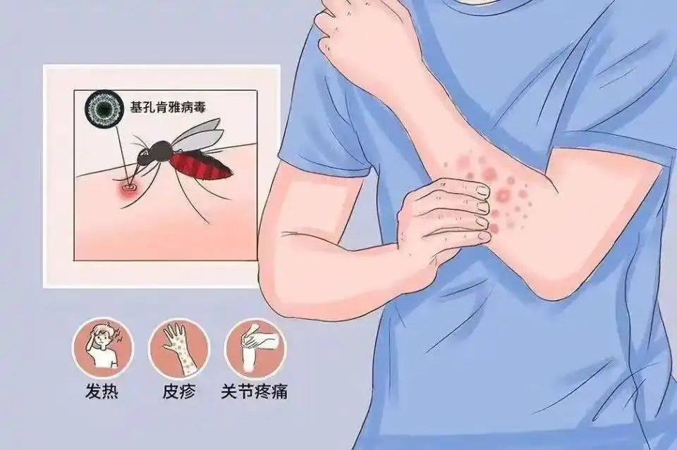 基孔肯尼亚热症状有哪些/基孔肯尼亚病毒图片
