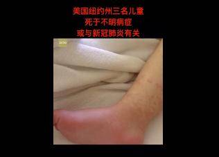 小孩新冠的最新症状和表现:小孩新冠的最新症状和表现是什么