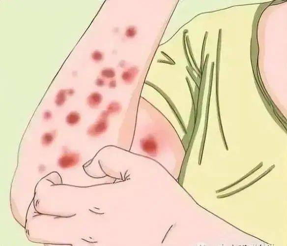 【基孔肯尼亚热皮疹图片/基孔肯尼亚病毒的临床表现】