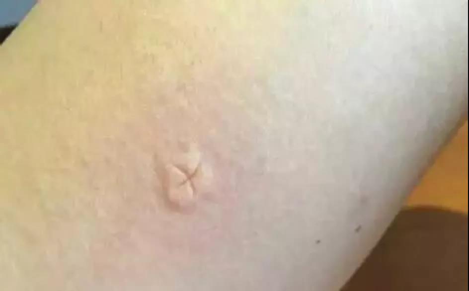 【伊蚊咬的包是什么样子,伊蚊叮的包】