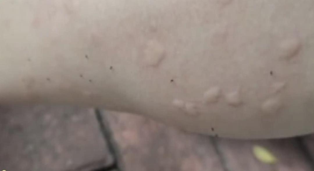【被黑白条纹蚊子咬了怎么办/被一只黑白条纹的虫子咬了】
