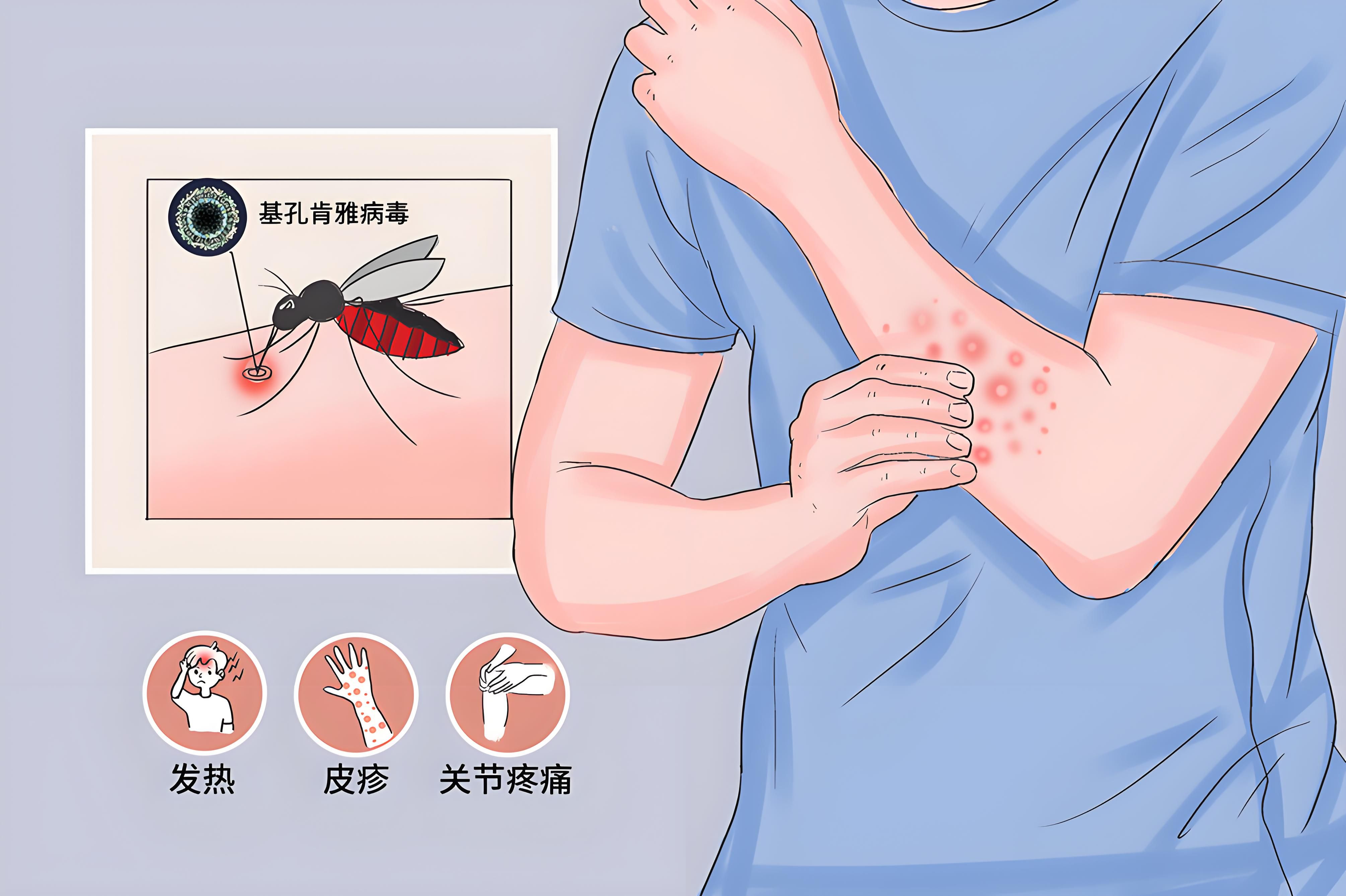 基孔肯尼亚与登革热区别（基孔肯尼亚病毒图片）