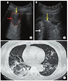 【安徽省新型冠状病毒新增病例/安徽省新型冠状病毒肺炎病例信息一览表】 【安徽省新型冠状病毒新增病例/安徽省新型冠状病毒肺炎病例信息一览表】